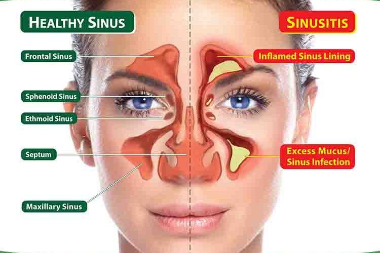 Sinus-Infection-750x500